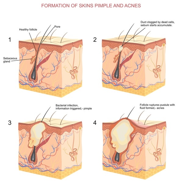 Formation of skins pimple and acnes - Image Copyright: logika600 / Shutterstock